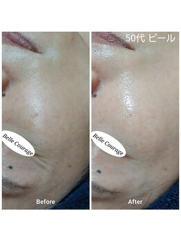 ベルクラージュ(Belle Courage)/40代　くすみ・毛穴・シワ