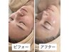 【美肌＋小顔＋首肩デコルテの贅沢ケア】￥22.000→18.800
