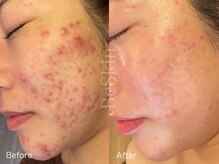 ビースキン 藤沢店(BeSkin)/もう良くならないと諦めていた肌