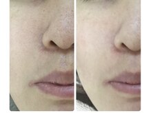 メイユール(MEILLEUR)/光フェイシャル1回