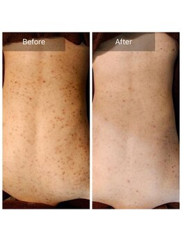 エミルカ(EMILUCA)/ハーブピーリングでお悩み改善