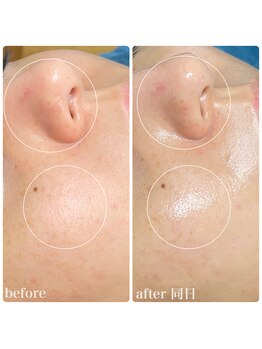 ちらちゅら/クリスティーナ【施術経過】