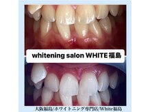 ホワイトニングサロン ホワイト(WHITE)/セルフホワイトニング/大阪/福島