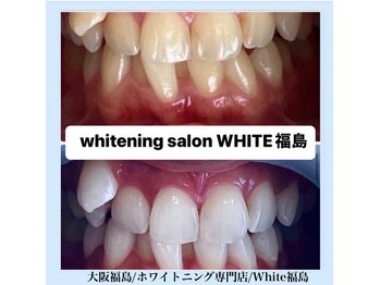 ホワイトニングサロン ホワイト(WHITE)/セルフホワイトニング/大阪/福島