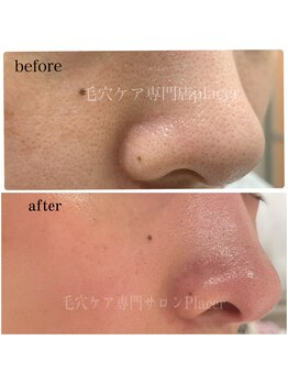 プラセル(Placer)/アラフォーのリアルその1/毛穴