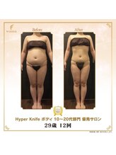 アチェリー(aCherry)/ハイパーナイフ痩身