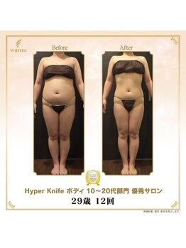 アチェリー(aCherry)/ハイパーナイフ痩身