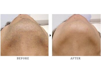 リノ(Lino)/メンズ髭脱毛☆