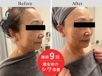 フフラ(Fufura)の写真/【医療提携】エクソソーム×神経幹細胞 最新エレポ機器でフェイシャル施術！EBG認定講師！