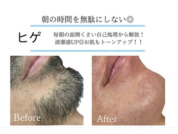 アルゴ 熊本健軍店(ALGO)/大大大人気!ヒゲ脱毛!