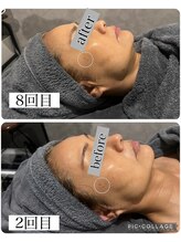 アンドココ(&coco)/ENVIRON トリートメント