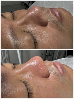 ナチュールムーン(Nature moon.)/男性　毛穴洗浄