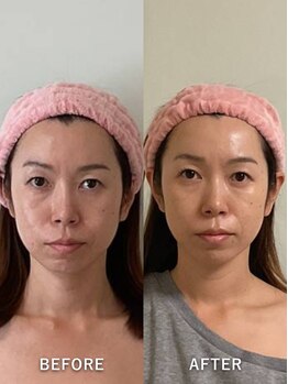 メディカルサロン レムリア/光糸リフト