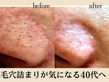 リアンジュ(Liange)/30代毛穴ビフォーアフター