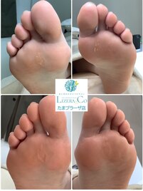 ウオノメケア/足裏トラブル改善