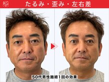 顔ジム 麻布店/50代男性顔ジム1回の効果
