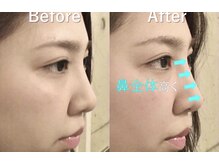 ラプリアンジュ 鹿児島天文館店(Raplit ange)/隆鼻+輪郭矯正40分　10回