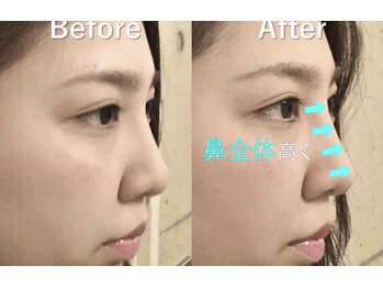 ラプリアンジュ 鹿児島天文館店(Raplit ange)/隆鼻+輪郭矯正40分 10回