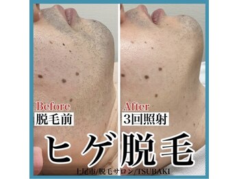 ツバキ(TSUBAKI)/ヒゲ脱毛