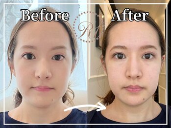 R-1ビューティーサロン 銀座/BEFORE＆AFTER　1回目