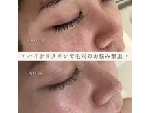 ファッショニスタ 恵比寿(Fashionista)の雰囲気（Fashionistaの毛穴洗浄の1回での効果絶大！ツヤ肌で更に可愛く♪）