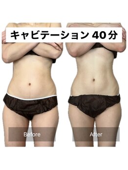 アネモネ/ダイエット/痩身/耳つぼ/腸活