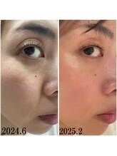 プラセル(Placer)/アラフォーのリアルその２/毛穴