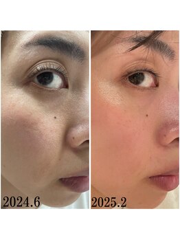 プラセル(Placer)/アラフォーのリアルその2/毛穴