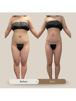 パリスヒロトン(PARIS HIROTON)/痩身症例写真(20代)