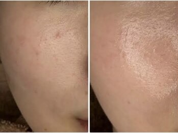 スムース イー(Smooth+E)/女性IPLフォト