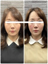 長寿鍼灸院 長寿整骨院/美容鍼50本の効果★ハリ・ツヤ