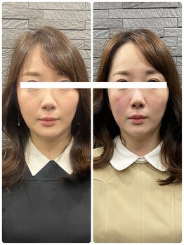 長寿鍼灸院 長寿整骨院/美容鍼50本の効果★ハリ・ツヤ