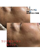 エミニナル(EMININAL)/ラジオ波、泡パック