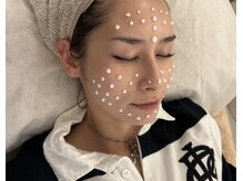 特許取得マイクロニードルショット使用韓国式フェイシャルエステ