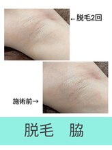 エミナル(EMINAL)/～脇脱毛の効果～女性
