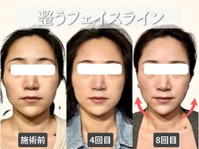フレキシボディ(FlexiBody)の雰囲気（すっきりしたフェイシャルラインほしくないですか？）