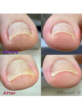 エレメントエヌ(Element N)/巻き爪補正