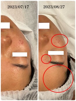 ハーシークレット(Her secret)/ハーブピーリング・ニキビケア