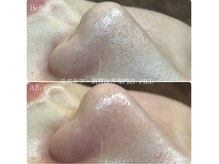 ピエル 北千住店(PIEL)/毛穴