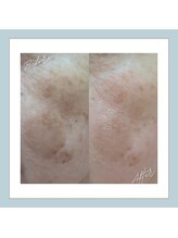 ラシュレ(BEAUTY CONCIERGE RASSURER)/シミ、しわ、たるみにもND-R！