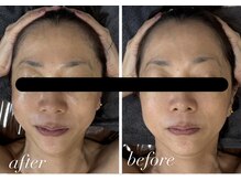 ビノスビューティー(vinos.beauty)/症例写真　小顔毛穴/たるみ