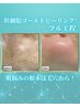 【毛穴×凸凹×ニキビ】組合せ最高峰プラン◎幹細胞ゴールドピーリング¥47000