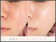 シャルム(Charme)/＼REVI★陶肌トリートメント／