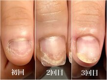 深爪 3回目での変化
