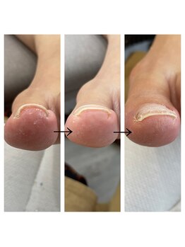 ミミ(mimi)/巻き爪ケア