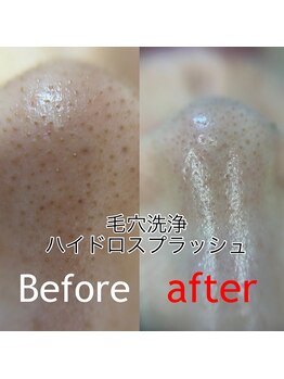 ルミエール(LUMIE’RE)/毛穴洗浄ハイドロスプラッシュ