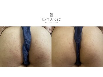 ボタニック 福津店(BoTANiC)/【ハーブピーリング】