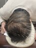 【育毛促進鍼（１００本コース）】髪毛が細く髪のボリュームが減った方