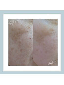 ラシュレ(BEAUTY CONCIERGE RASSURER)/シミ、しわ、たるみにもND-R！