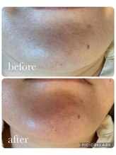 オゾンレメディ(O3remedy)/毛穴洗浄